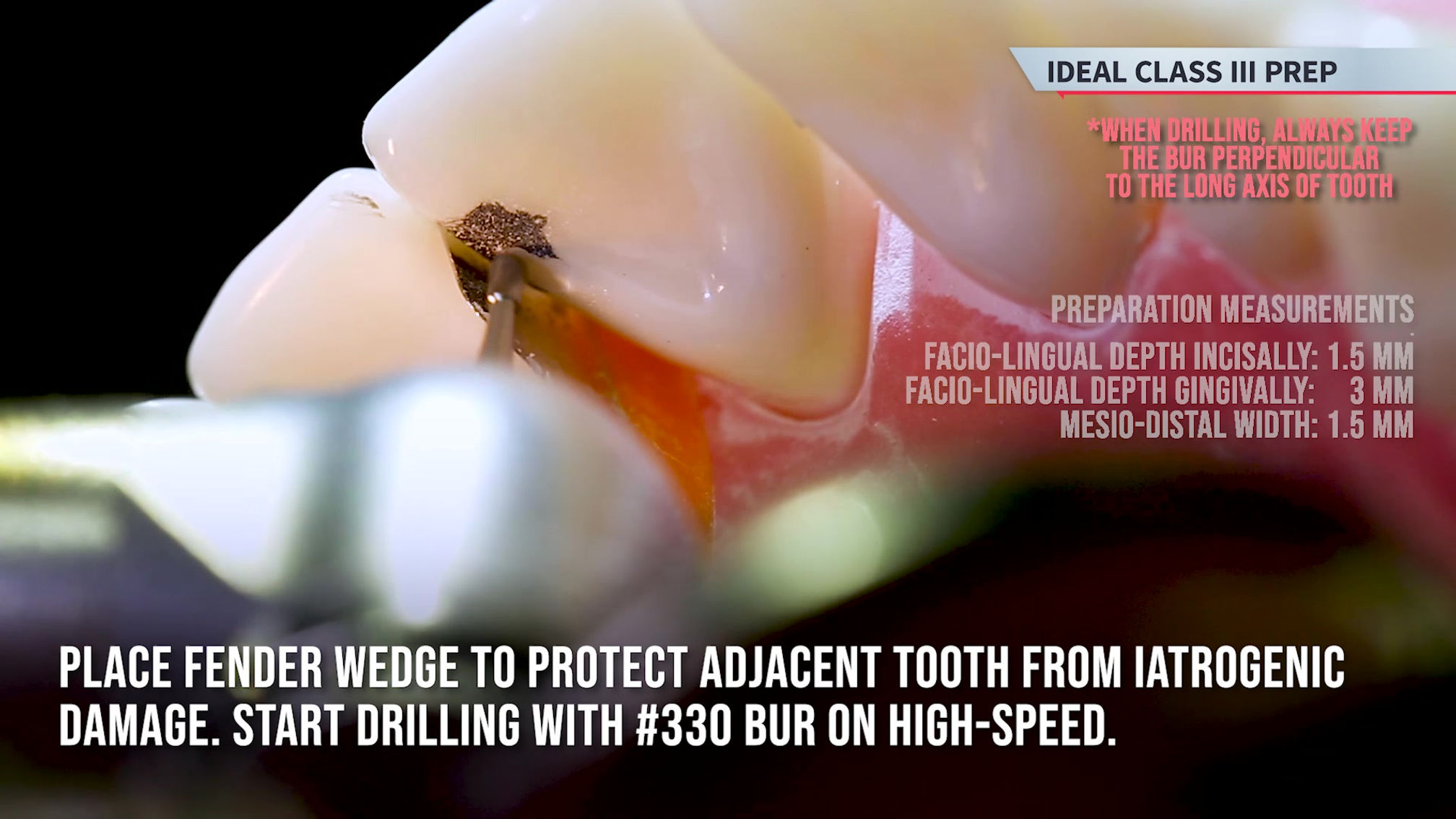 Class III Preparation